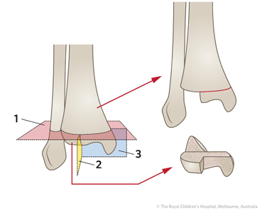 Figure 3 TRIPLANE fracturev2